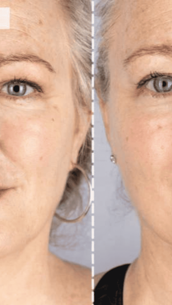 red light therapy at home before and after
