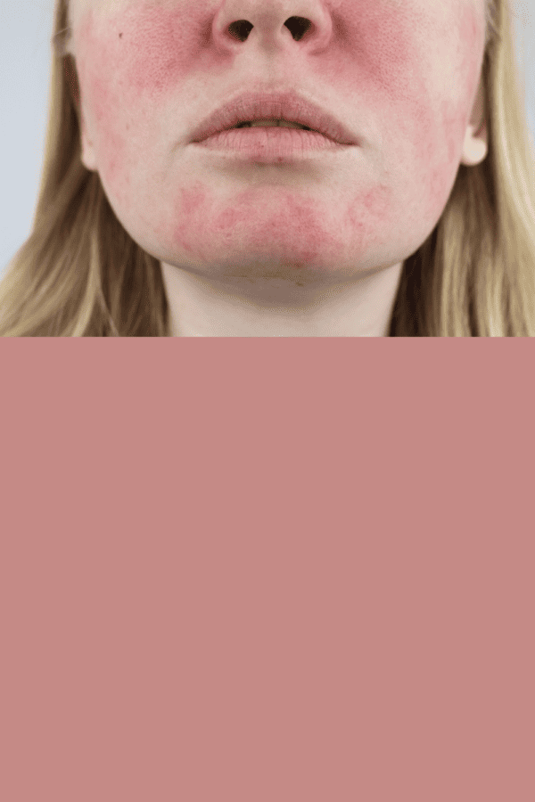 Peeling Makeup Problem Can I Wear Makeup After a Chemical Peel? The Dos and Dont's